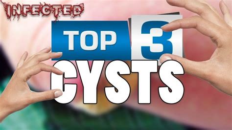 Image result for Cyst Extraction Videos