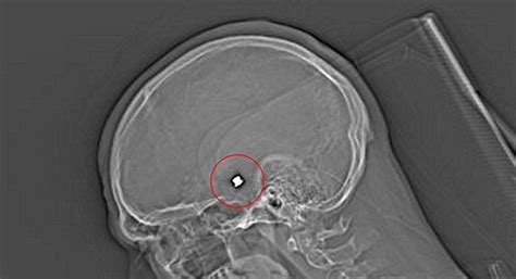 Miraculous! Man Survives Shot In The Head As Bullet Passes Through ...