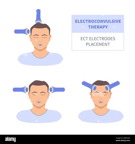 ECT electroconvulsive therapy for severe depression treatment Stock Vector Image & Art - Alamy