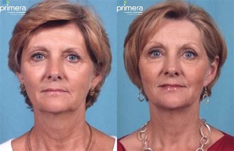 Endoscopic Forehead Lift for Orlando, Winter Park & Tampa, FL - Primera ...