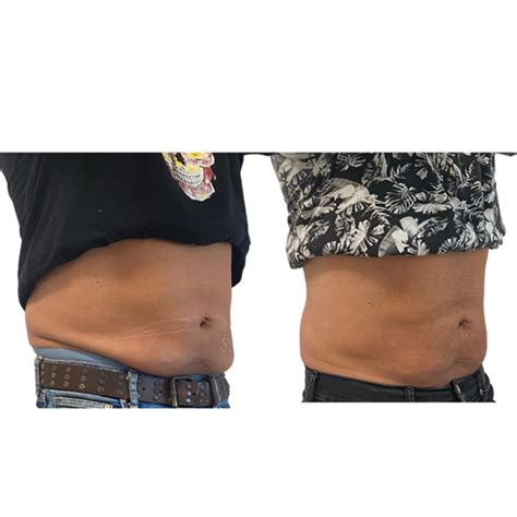 Flacidez y Celulitis - Estética Fira