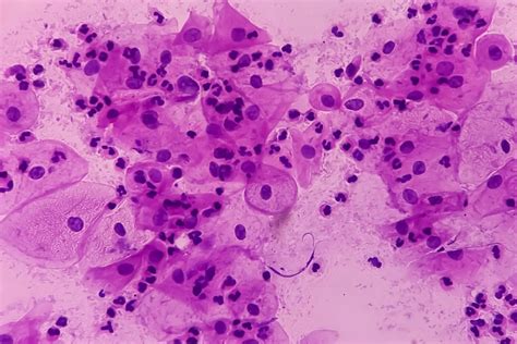Another screening success story: England changes cervical screening to every 5 years - Cancer ...