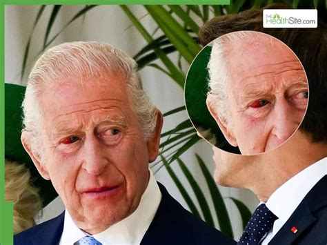 King Charles Health BIG Update: Is King Charles Dying? UK Monarch ...