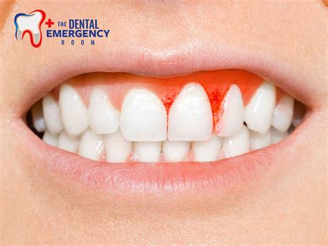 Image result for Pulled Tooth