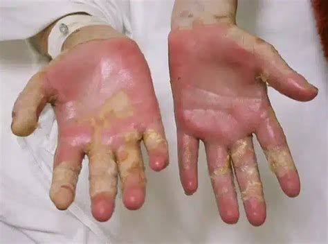 What is Toxic Epidermal Necrolysis (TEN)?