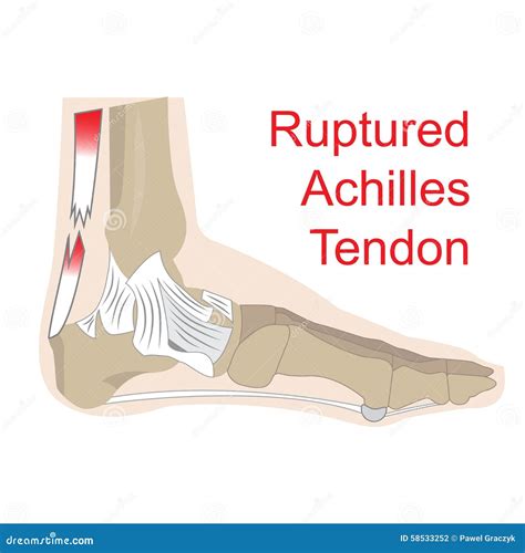Ruptured Achilles Tendon Stock Vector - Image: 58533252