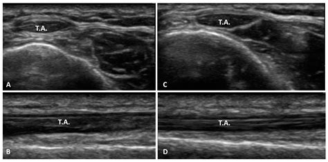 Ultrasound Imaging in Football Players with Previous Multiple Ankle ...