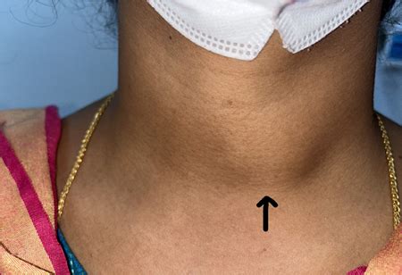 Thyroid Surgery in Hyderabad | Dr Rahul Buggaveeti