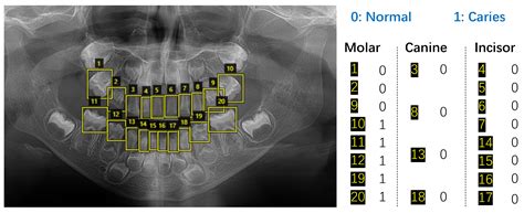 Dental Caries X Ray