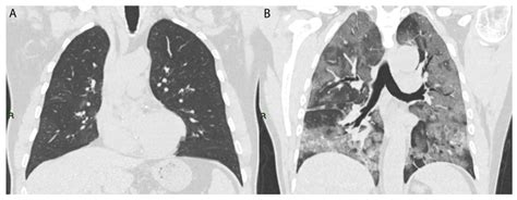 COVID-19 in Italy: Comparison of CT Findings from Time Zero to the ...