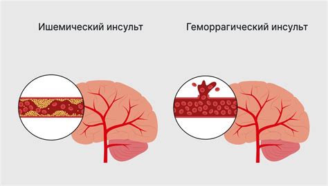Инсульт - что это, как распознать, признаки и симптомы