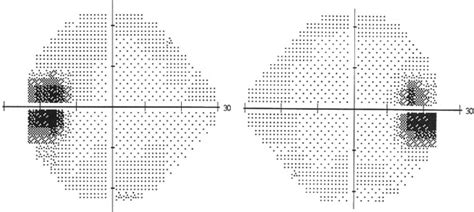 Image result for Check Visual Fields