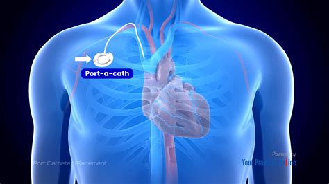 What Is Porta Catheter at Nell Velez blog