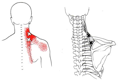Levator Scapulae | The Trigger Point & Referred Pain Guide