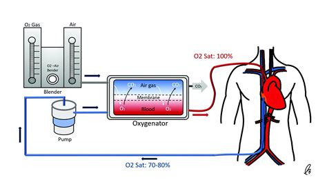 Image result for ECMO Procedure