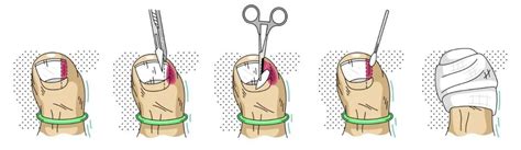 Image result for Toe Surgery