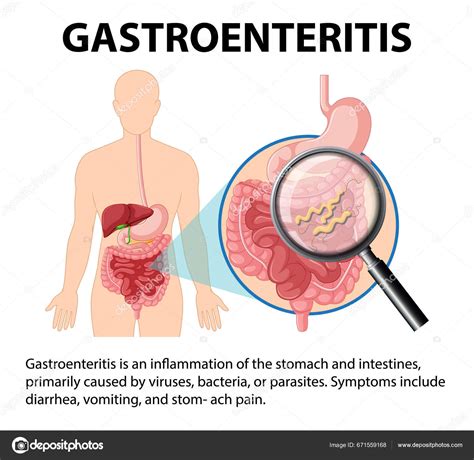 Que Es Gastroenteritis