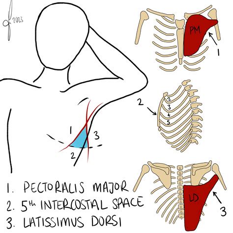 Image result for Locating Needle Decompression Site Using Open Hand as Guide