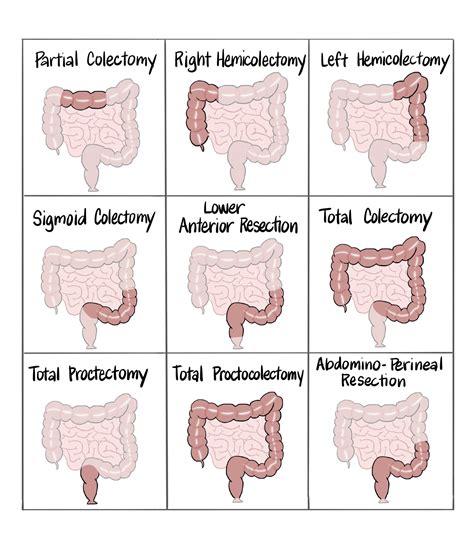 What kinds of surgery are there? - Colontown University