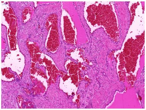 C-KIT Expression in Orbital Cavernous Venous Hemangiomas