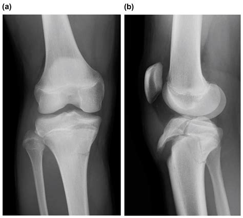 Type V Tibial Tubercle Avulsion Fracture with Suspected Complication of ...
