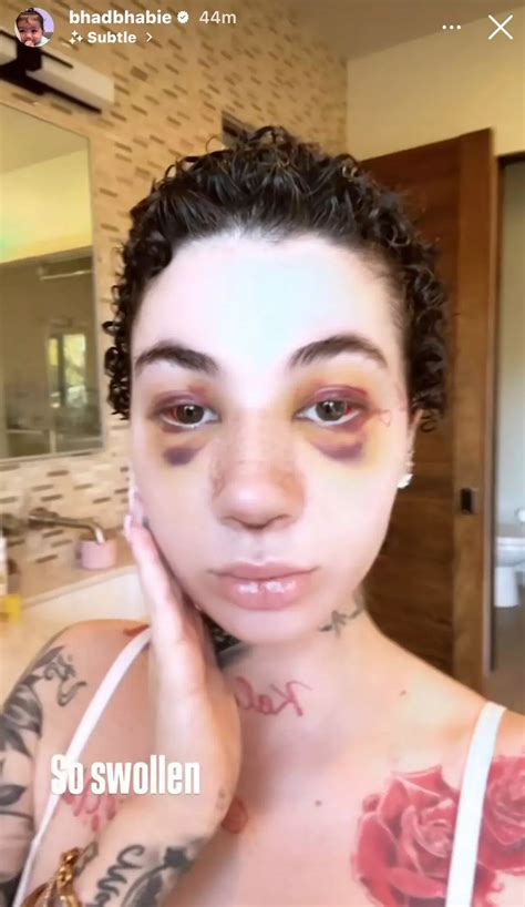 Bhad Bhabie shares graphic nose job update amid cancer diagnosis - The ...