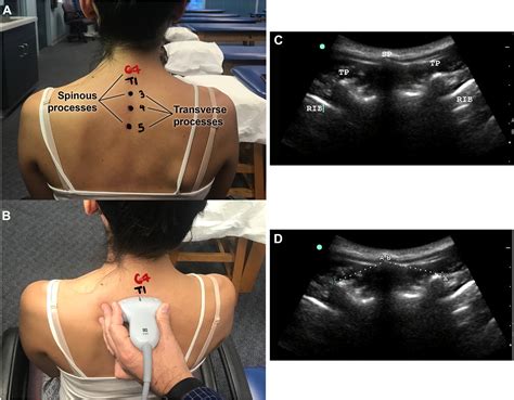 Evaluating for a correlation between osteopathic examination and ultrasonography on thoracic ...