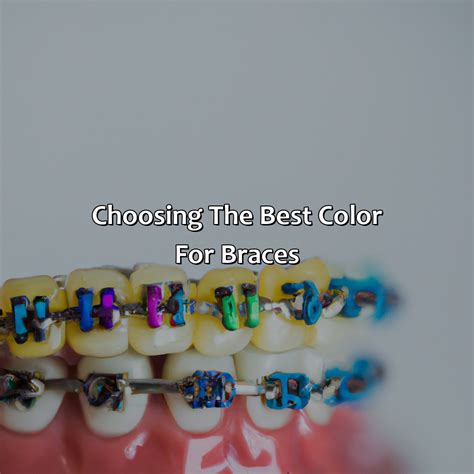 How To Choose A Color For Braces at Alyssa Wekey blog