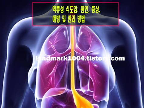 역류성 식도염: 원인, 증상, 예방 및 관리 방법