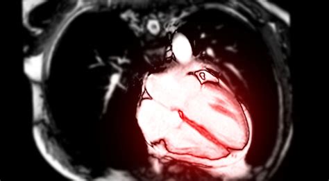 Myocarditis and COVID vaccines, explained | Popular Science