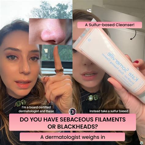 What You See on Your Nose Aren’t Blackheads. Dermatologist Shares What It Is and How to Treat It