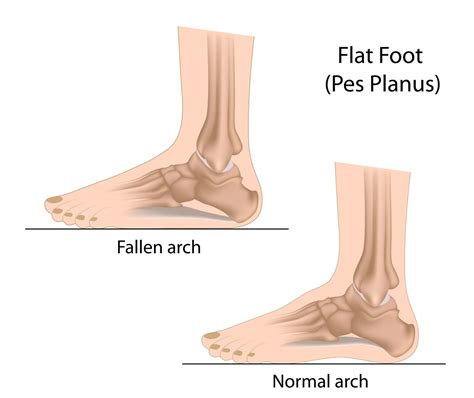 Flat feet: Symptoms, Causes and Risk factors
