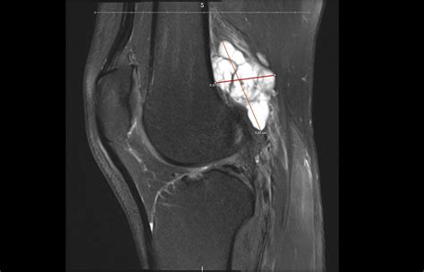 Ganglion Cyst Knee
