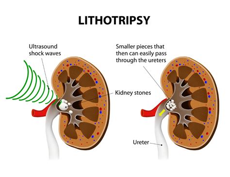 Lithotripsy Procedure 的图像结果