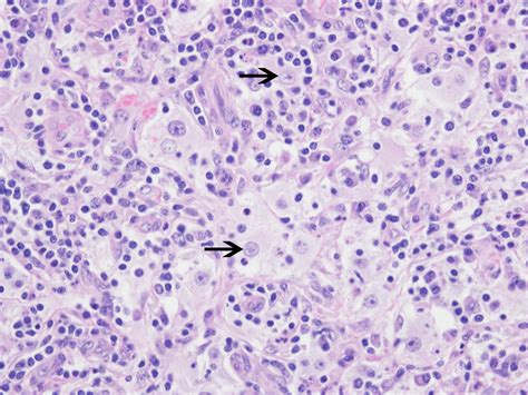 Pathology Outlines - Rosai-Dorfman disease (RDD)