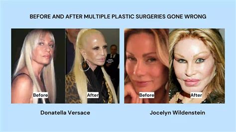Before And After Plastic Surgery Gone Wrong Jaw Surgery Before & After