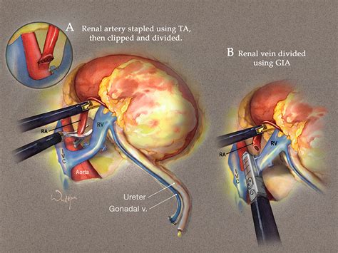 Image result for Hal Nephrectomy