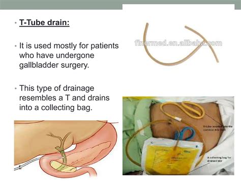 Gallbladder Drainage Tube After Surgery | The Tube