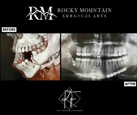 Facial Trauma Surgery in Lone Tree, CO | Rocky Mountain Surgical Arts