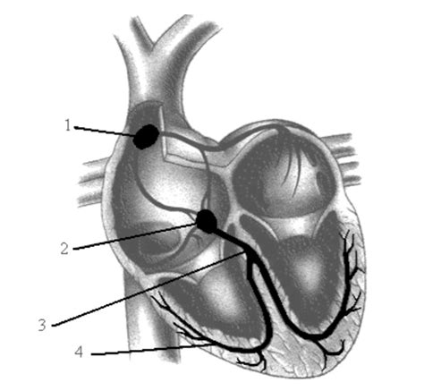 Image result for Cardiac Conduction System Disorders