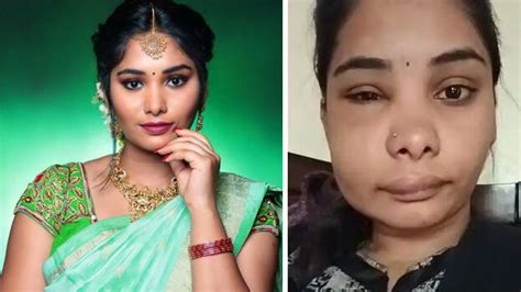 Kannada actress' face looks unrecognizable and disfigured; given ...