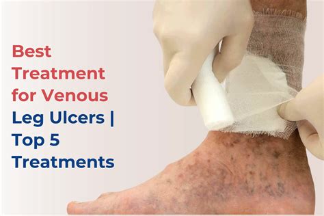 Best Treatment for Venous Leg Ulcers | Top 5 Treatments