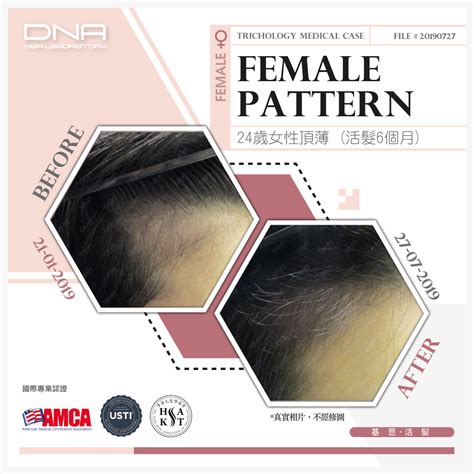 24-Year-Old Woman Experienced Widening Hairline and Significant Front ...