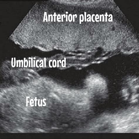Everything about the placenta. Ultrasound included. - Ultrasoundfeminsider