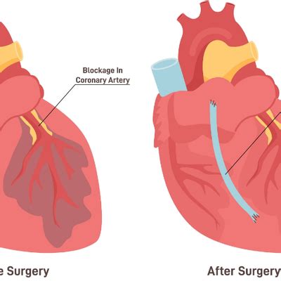 CABG Surgery Explained: Coronary Artery Bypass Graft Basics