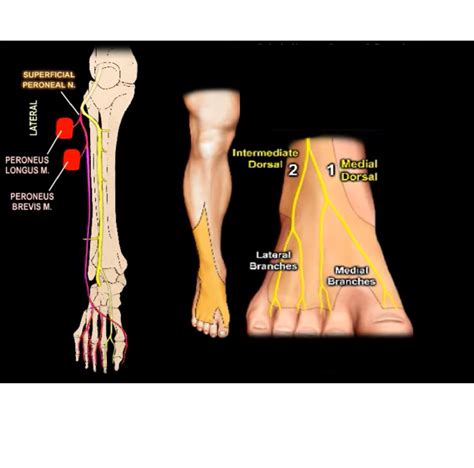 Where Is My Sciatic Nerve – Piriformis Syndrome: Symptoms and How to Manage It – OVPORC