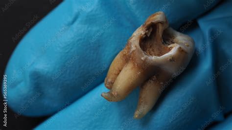 Decayed Tooth Pulling 的图像结果