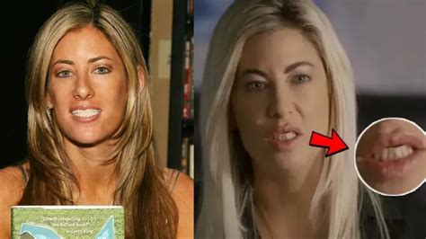 Rex Ryan Teeth Before and After Fixed 2024