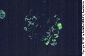 Focal Segmental Glomerulosclerosis - Focal Segmental Glomerulosclerosis ...