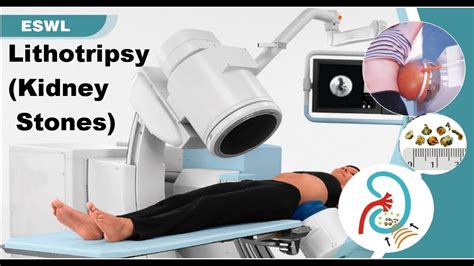 Lithotripsy Procedure 的图像结果